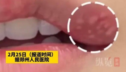 女子嘴角起泡未重视竟导致脑死亡，医生紧急提醒：口唇疱疹伴发热头痛速就医