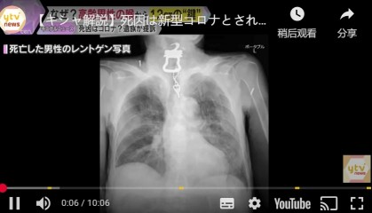 日本82岁老人喉咙痛被确诊新冠病死， X光发现是钥匙卡喉咙