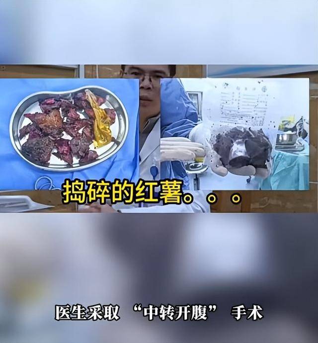 61岁男子将17cm红薯塞入肛门，半夜疼痛难忍被迫就医，医生：尺寸过大，得开腹