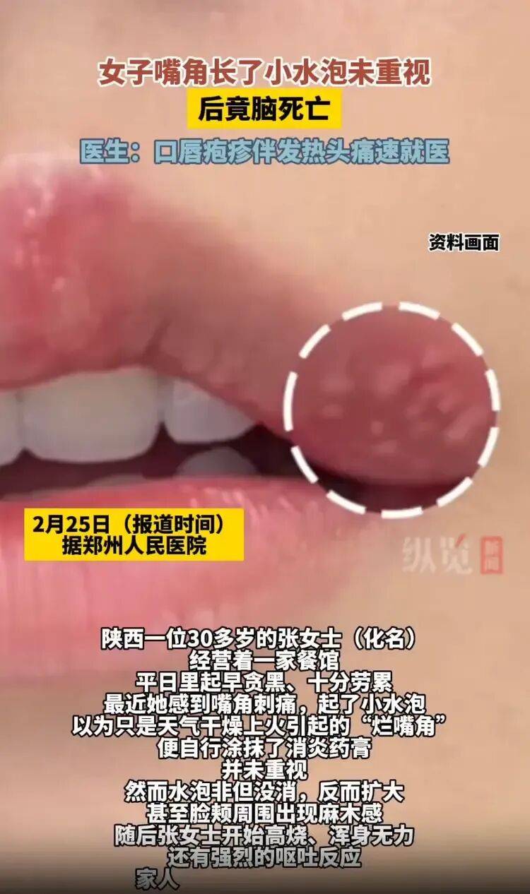 女子嘴角起泡未重视竟导致脑死亡，医生紧急提醒：口唇疱疹伴发热头痛速就医